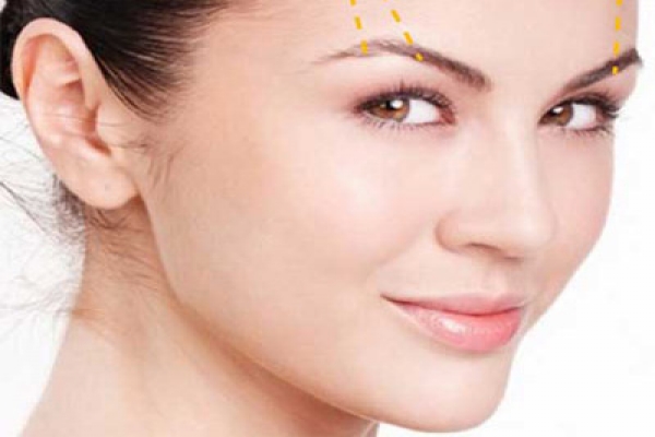 Tiêm filler tạo sống mũi