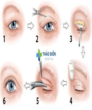 Cắt da mỡ thừa mí mắt