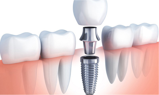 CẤY GHÉP IMPLANT