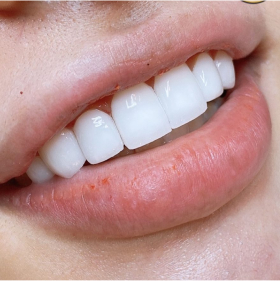 Dòng sứ Cercon HT
