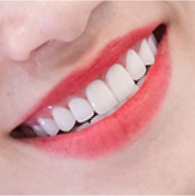 Dòng sứ Lava Esthetic 3M