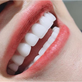 Dòng sứ Zirconia