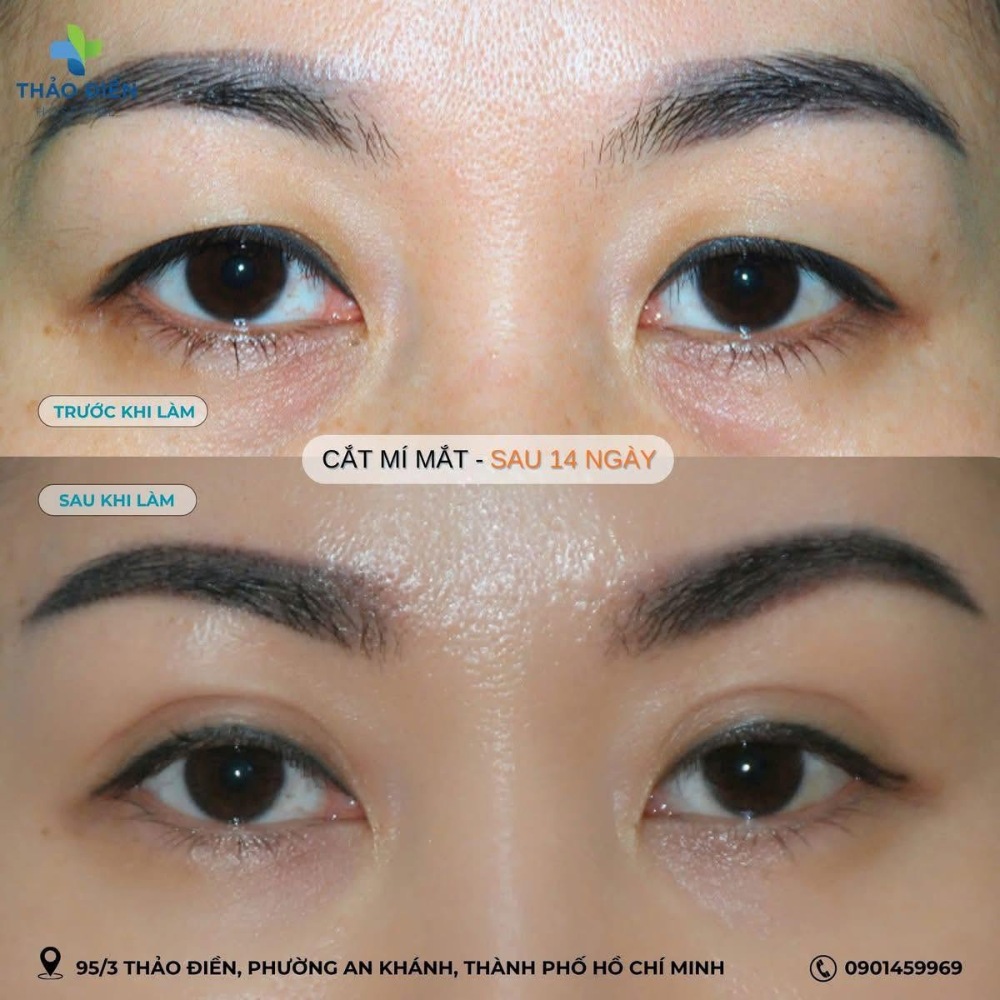 bao lâu mí mắt hồi phục sau khi cắt chỉ