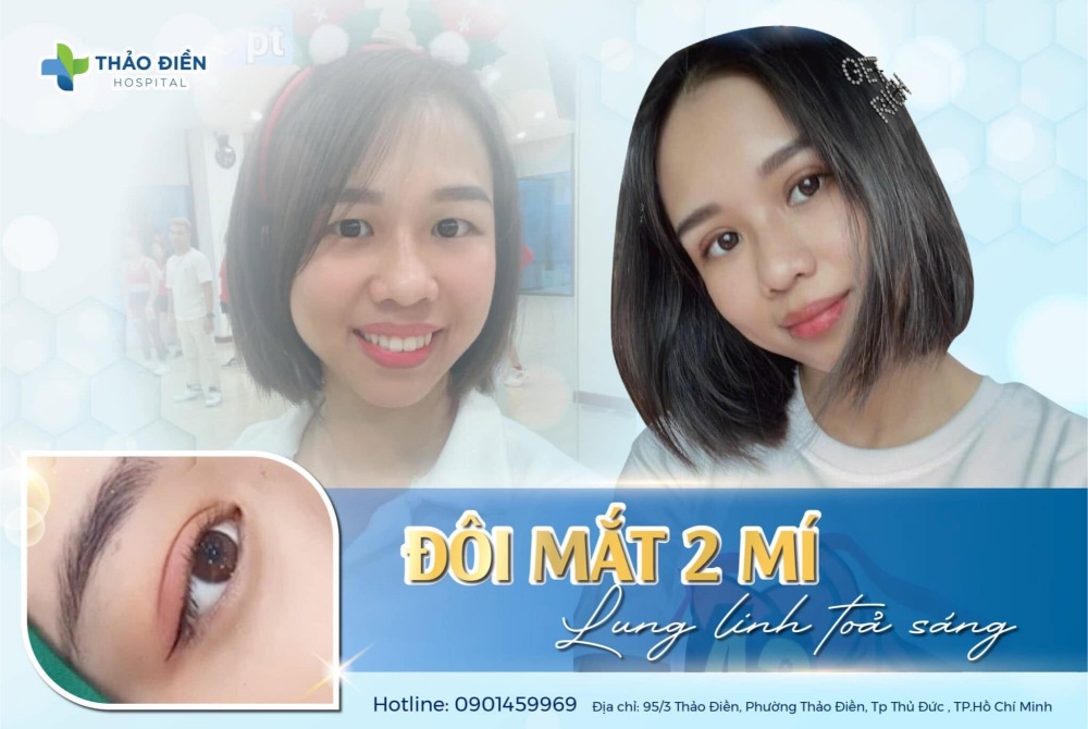 cắt mí mắt ở bệnh viện thảo điền