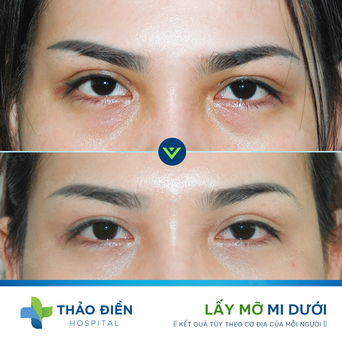 cắt da thừa mí mắt ở đâu đẹp