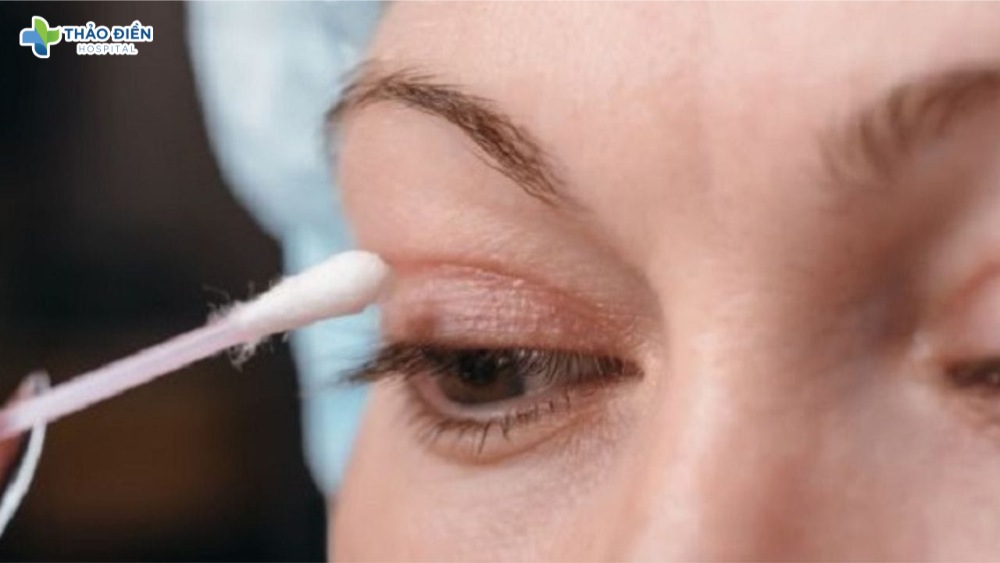 cách chăm sóc mí mắt không để lại sẹo