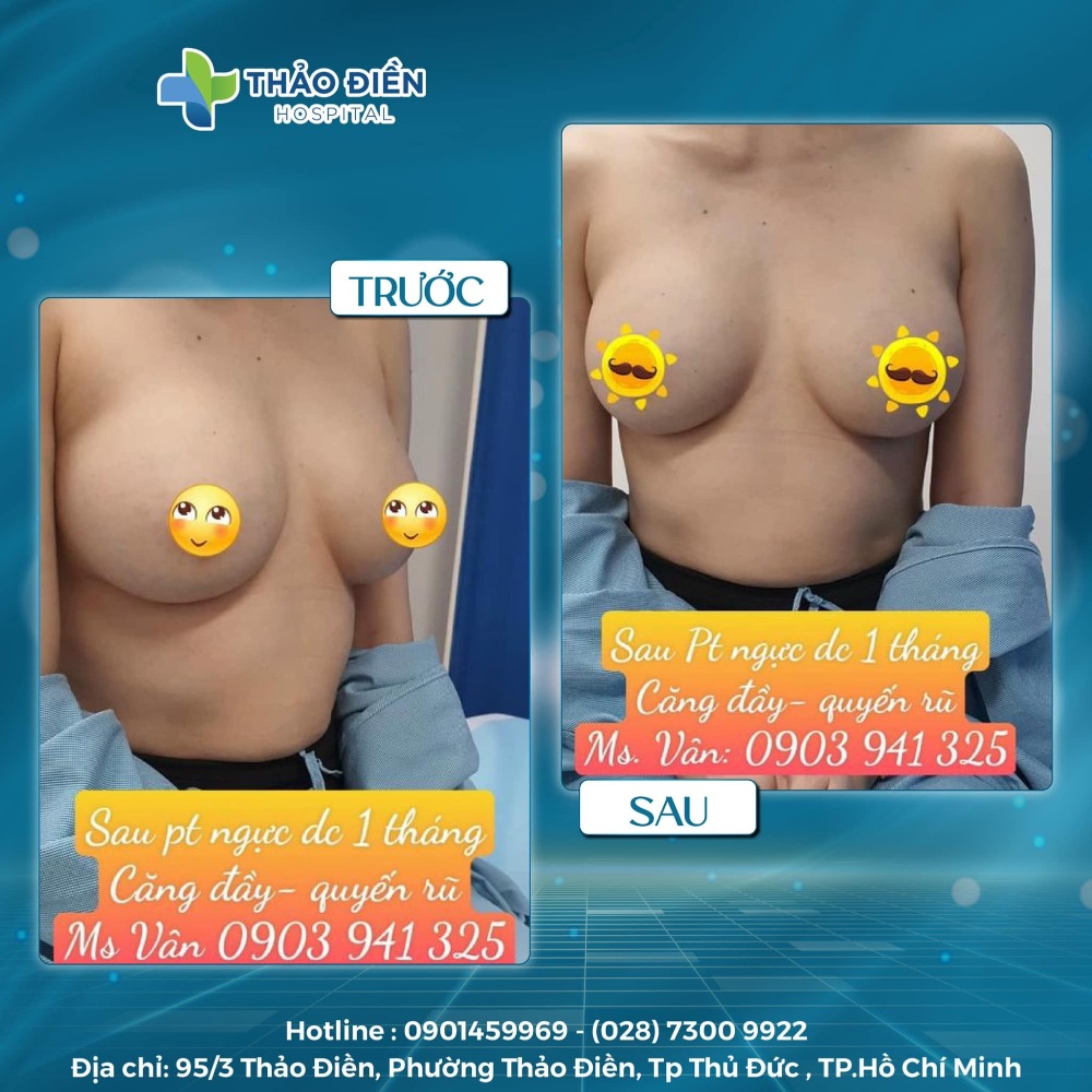 nâng ngực bằng túi độn bệnh viện thảo điền