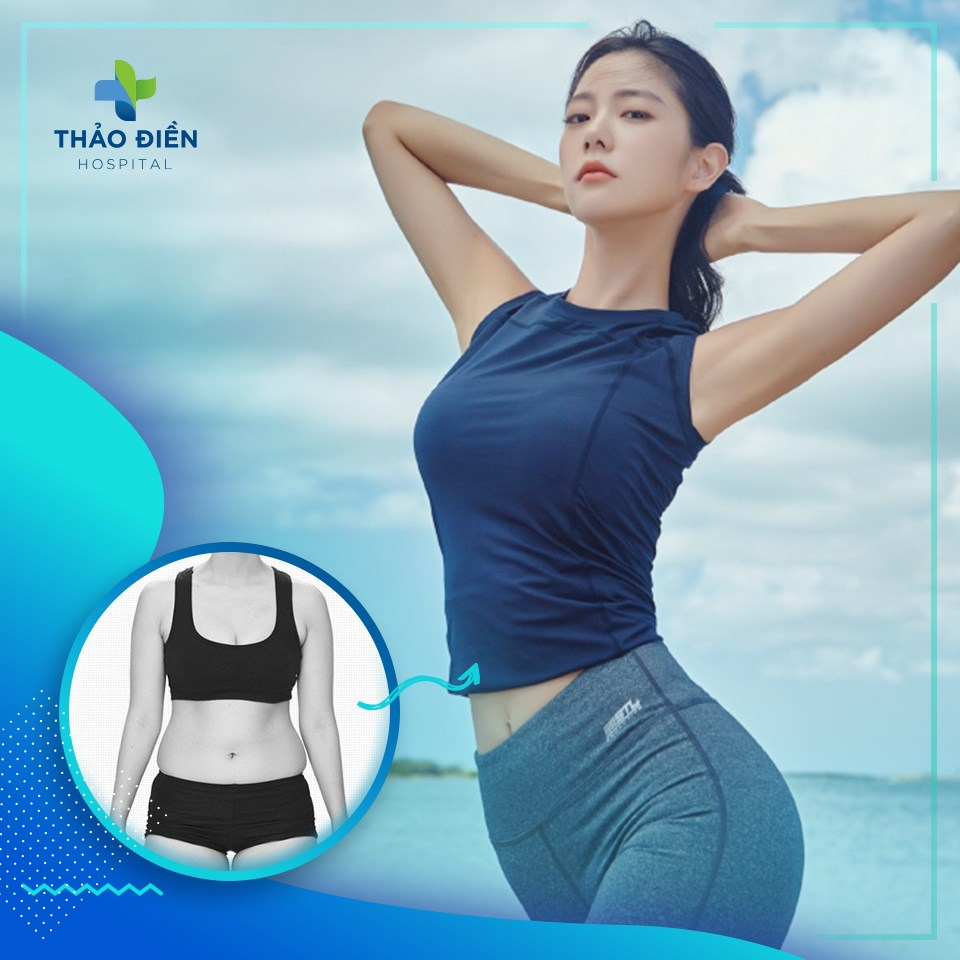 hút mỡ bụng bao lâu thì lành