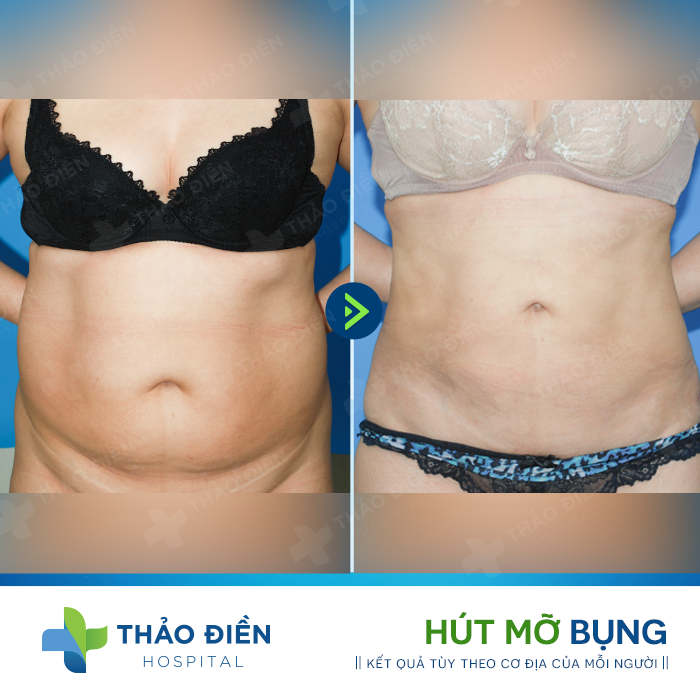 hút mỡ bụng có sẹo không