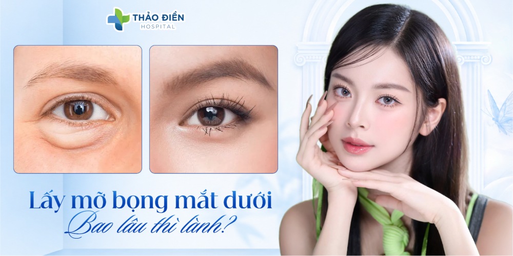 Lấy mỡ bọng mắt dưới bao lâu thì lành? Một số câu hỏi thường gặp