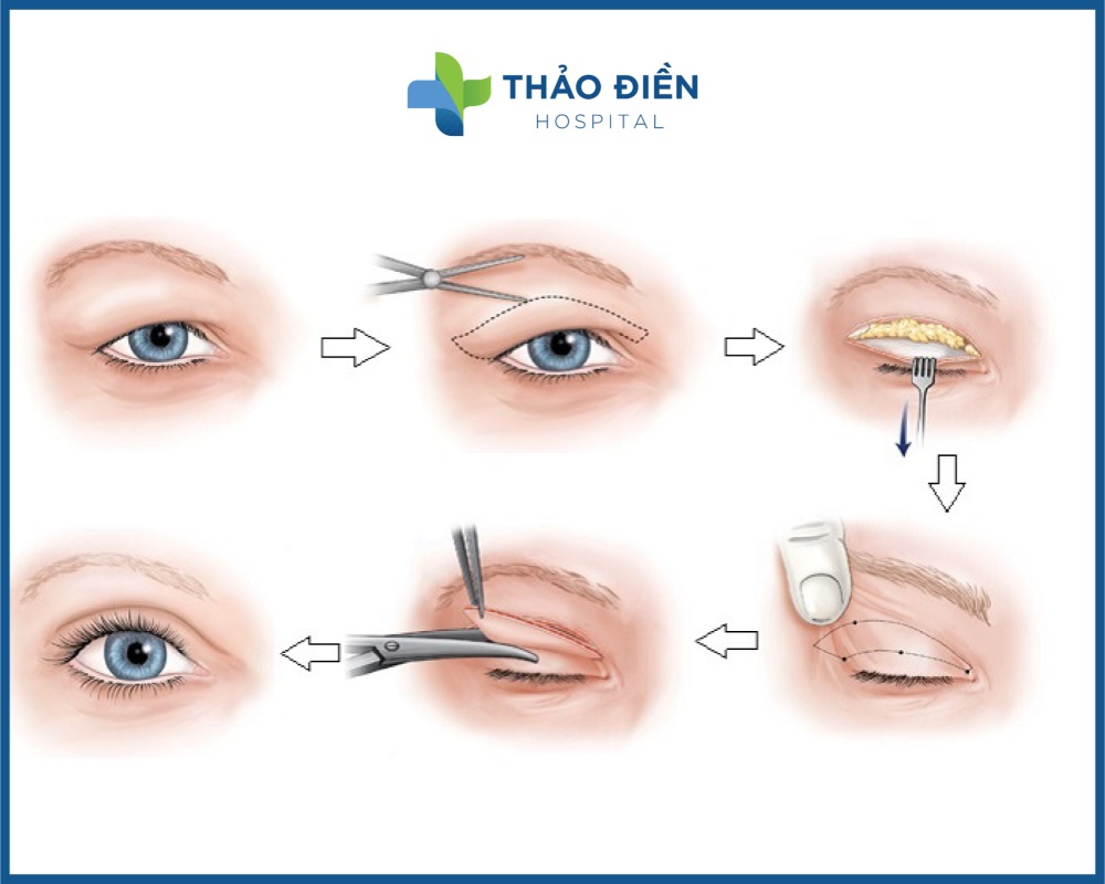 có nên lấy mỡ bọng mắt không