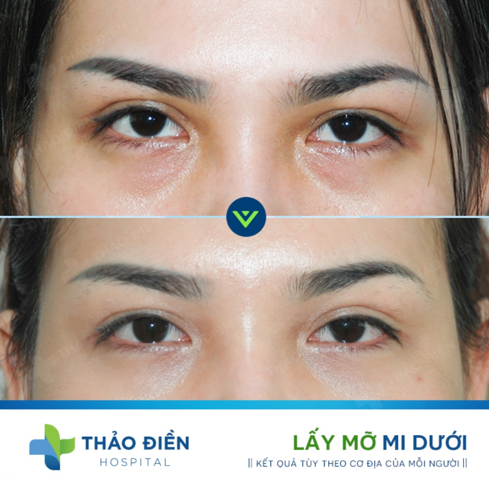 lấy mỡ bọng mắt ở đâu uy tín TPHCM