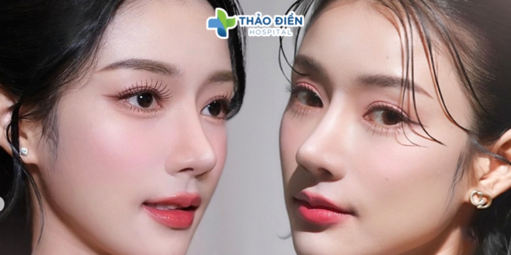 nâng mũi S line và mũi L line