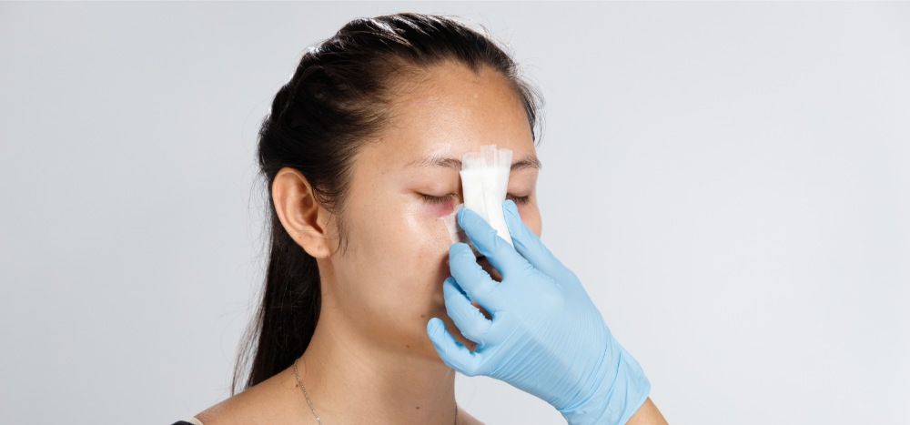 yếu tố nâng mũi cấu trúc bao lâu thì đẹp