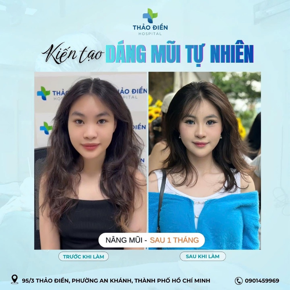 nâng mũi cấu trúc ở đâu an toàn