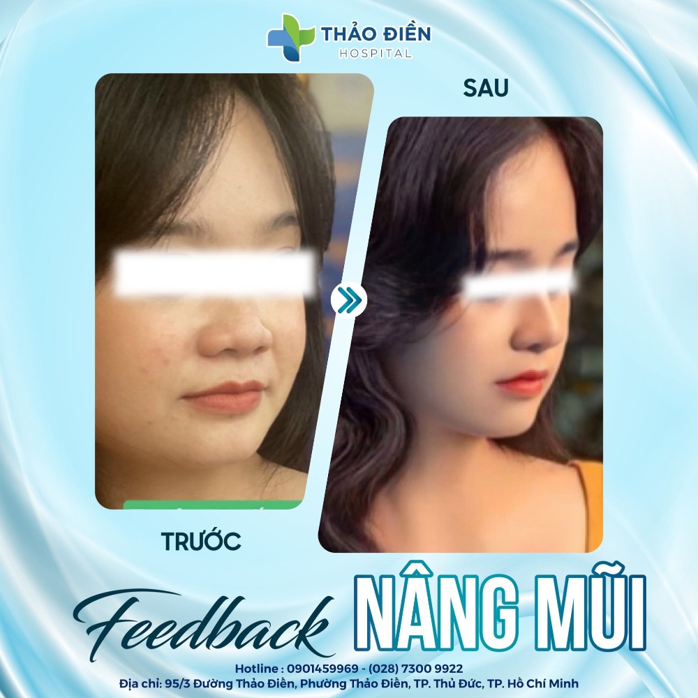 nâng mũi cấu trúc bao lâu thì đẹp