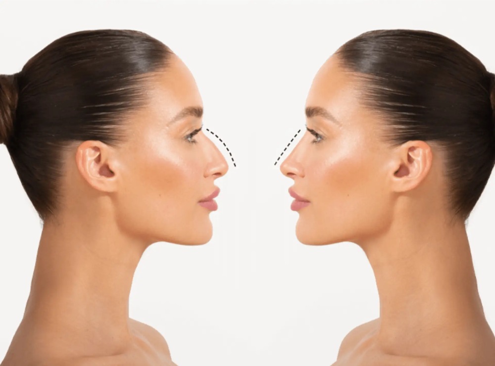 nâng mũi cấu trúc giữ được bao lâu