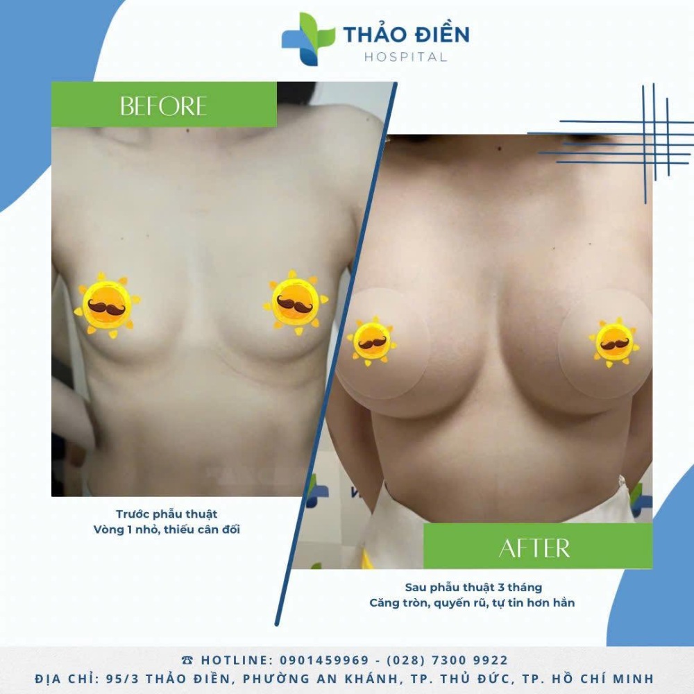 nâng ngực bằng mỡ tự thân an toàn tại bệnh viện thảo điền