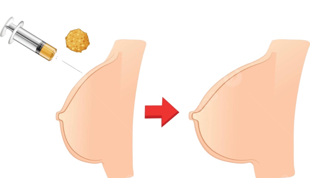 có nên nâng ngực bằng mỡ tự thân