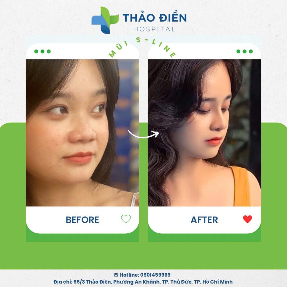 nâng mũi cấu trúc là gì