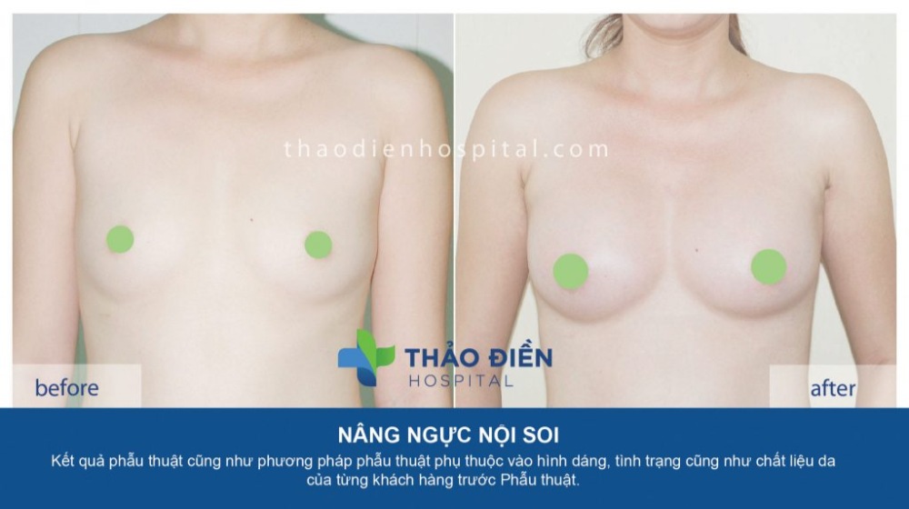 hướng dẫn chăm sóc sau phẫu thuật nâng ngực