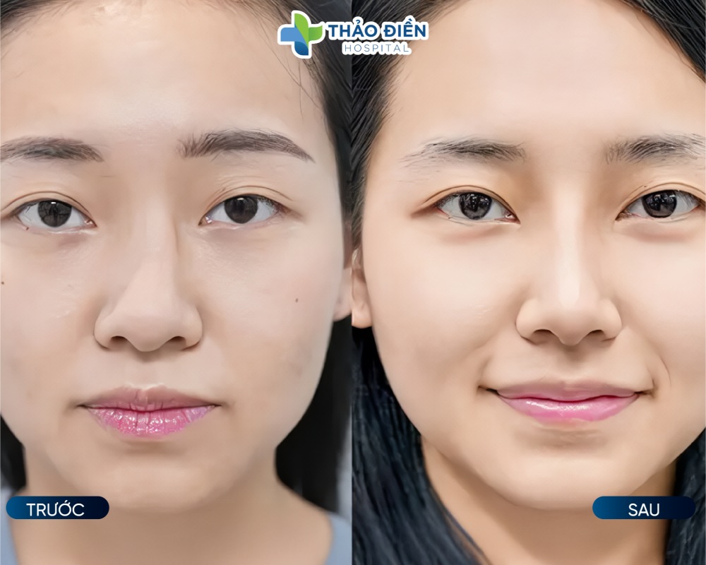 sửa mũi bao lâu thì lành