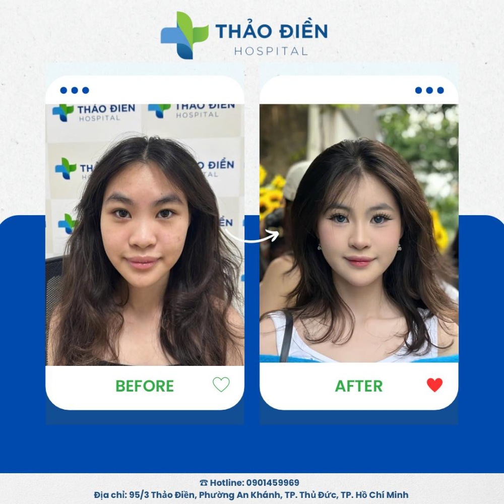 sửa mũi bao lâu thì hết sưng