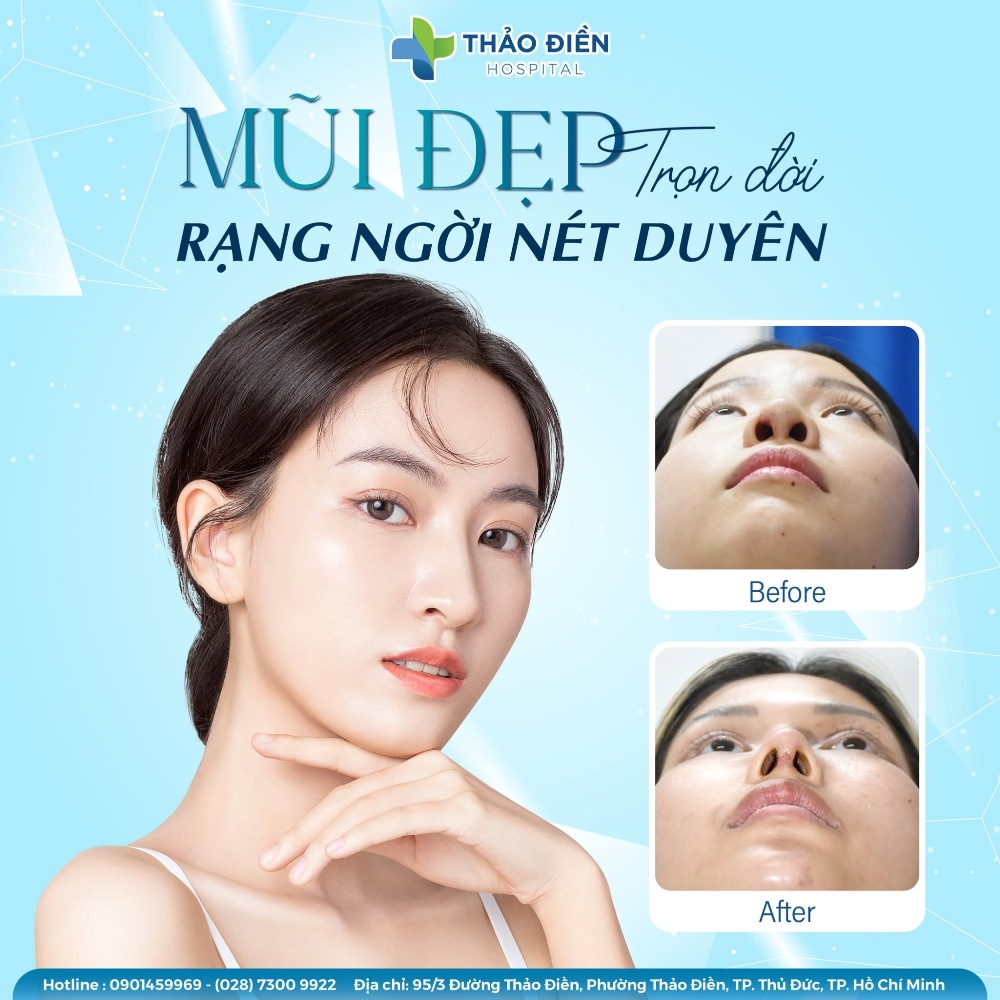 thu nhỏ cánh mũi tự nhiên